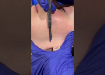 Dermaplaning at CosMedicLaserMD! 🌟